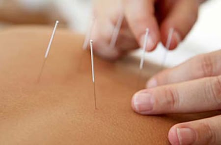 Dry needling