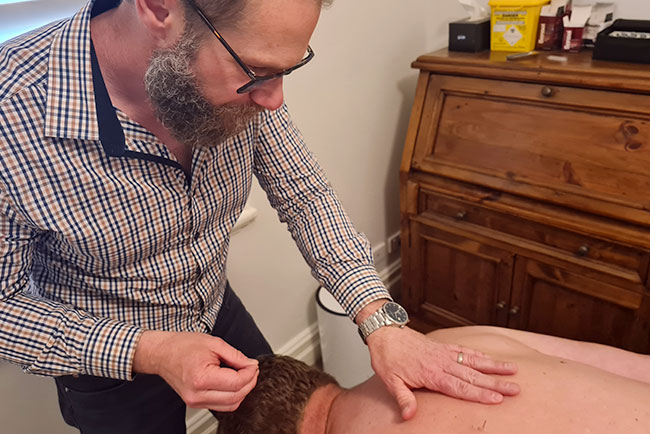 Chris Booth performing acupuncture treatment on a patient