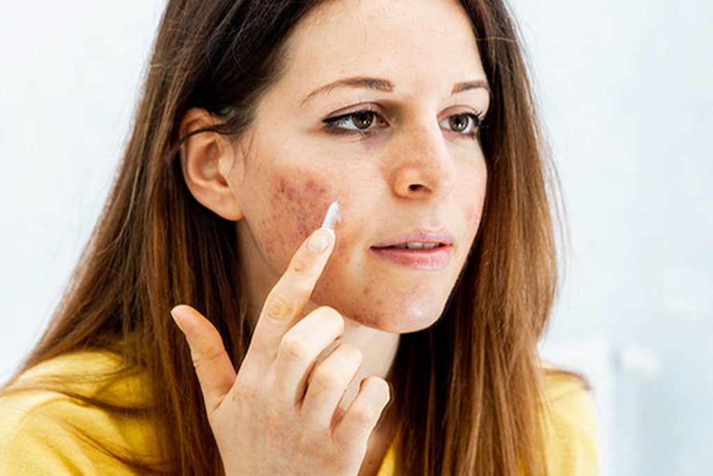 Young woman with skin problems