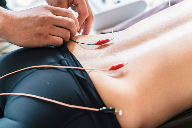 Therapist giving Electro Acupuncture treatment