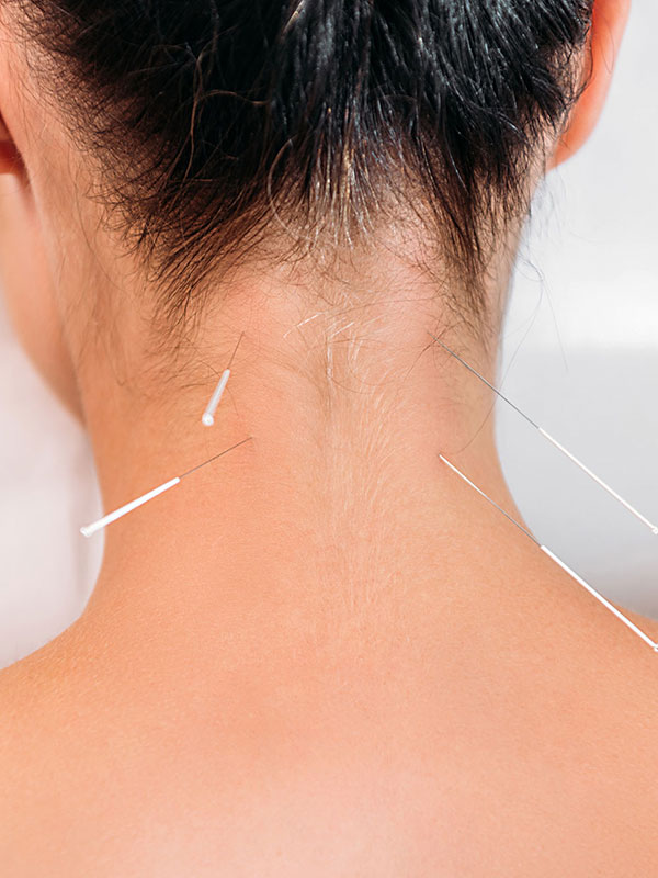 Young woman getting acupuncture treatment on back of the neck